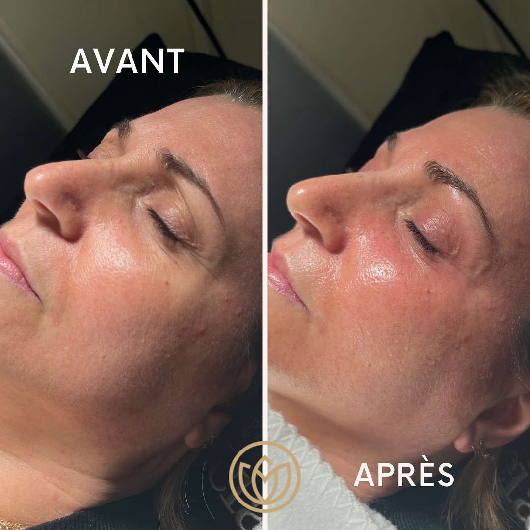 Avant/Après Blanchiment Dentaire