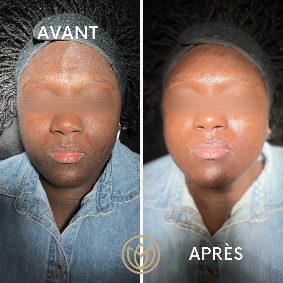 Avant/Après Épilation Laser
